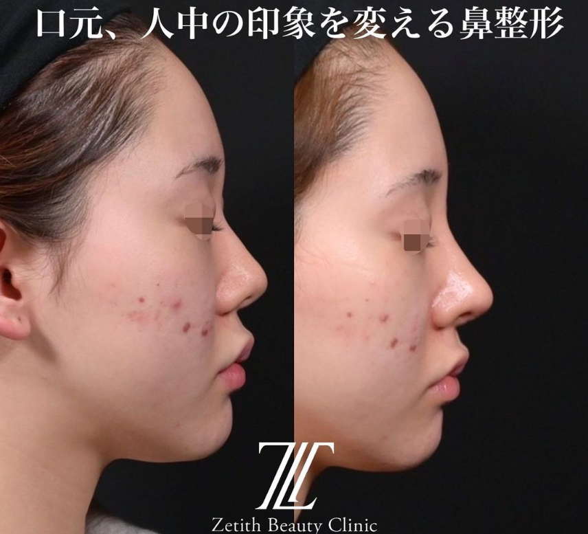 鉄医師による鼻のフルコースの施術前／施術後1ヶ月