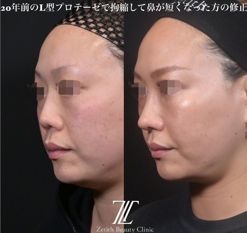鉄医師による鼻のフルコースの施術前／施術後3ヶ月 术后 
