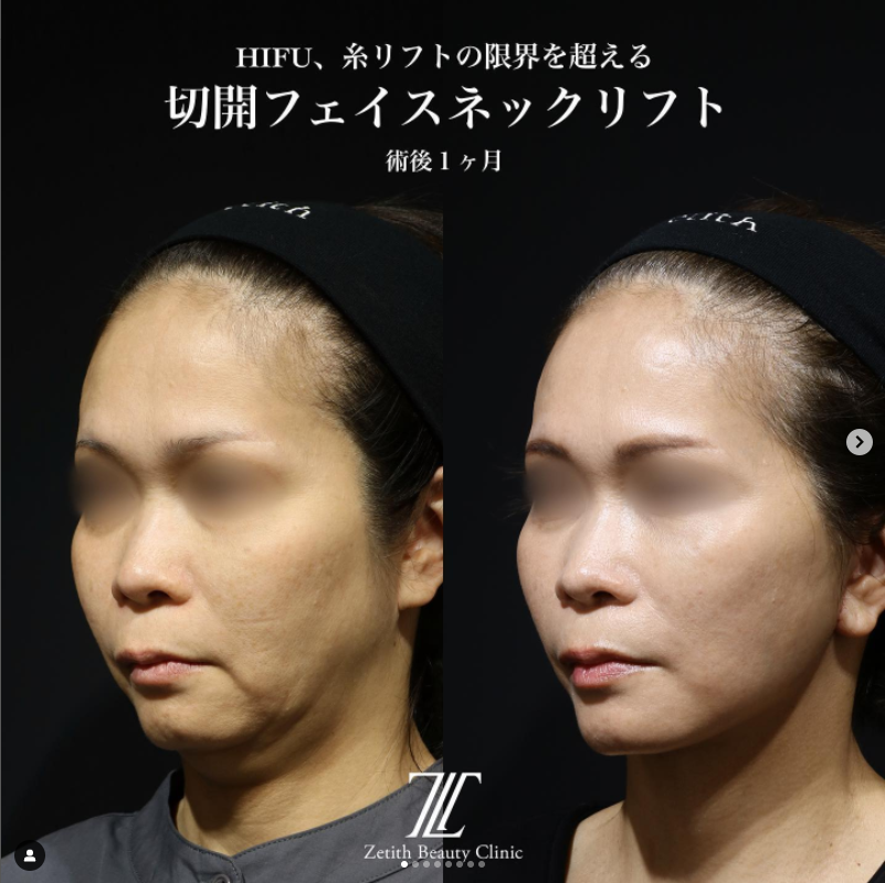 《術後1ヶ月》王医師によるフェイスリフト＋ネックリフト