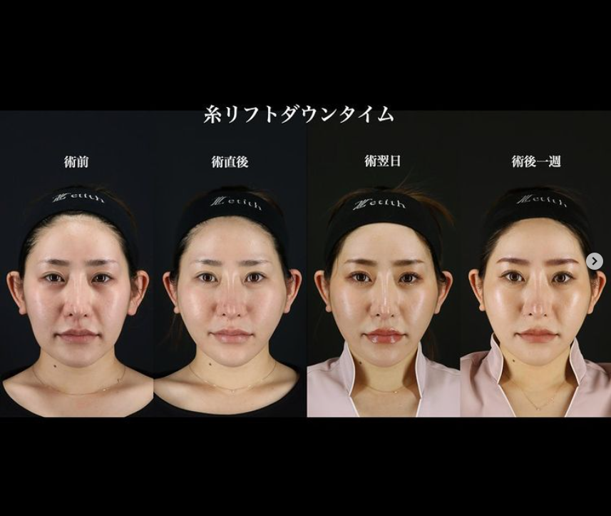 《術後経過》王医師による糸リフト