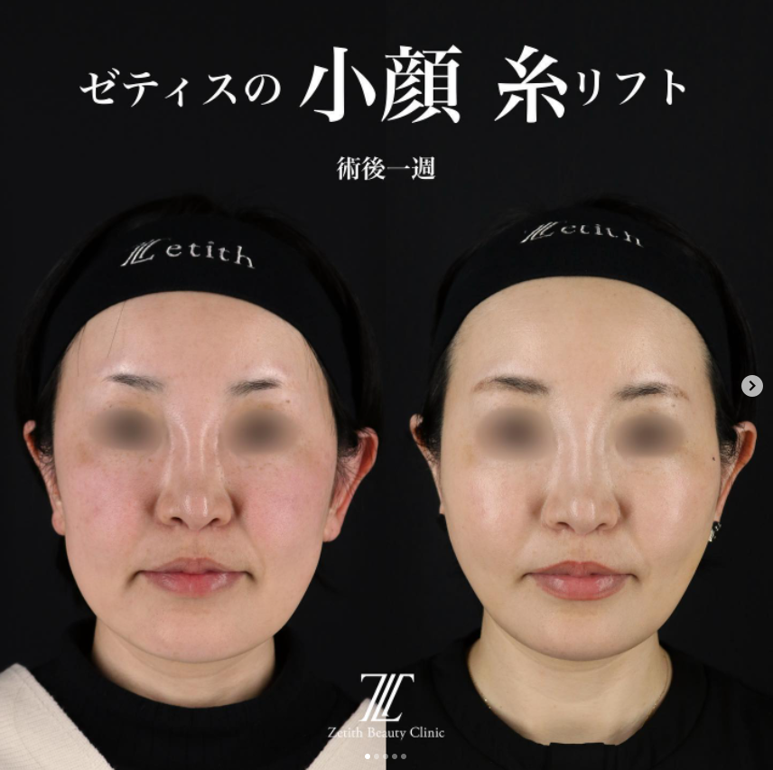 《術後1週間》王医師による糸リフト