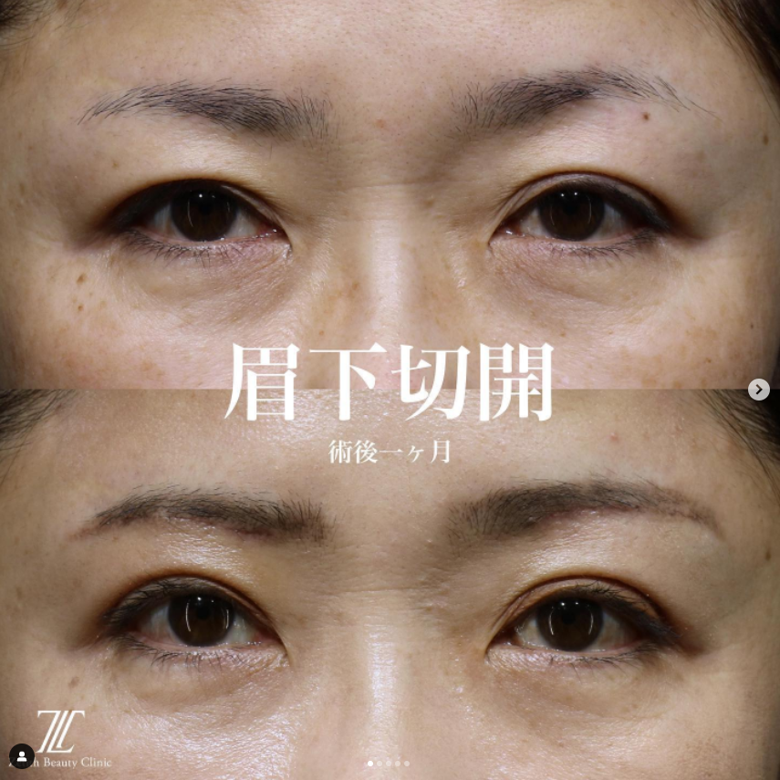 《術後1ヶ月》王医師による眉下切開