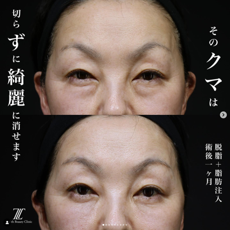 《術後1ヶ月》王医師によるクマ取り＋脂肪注入