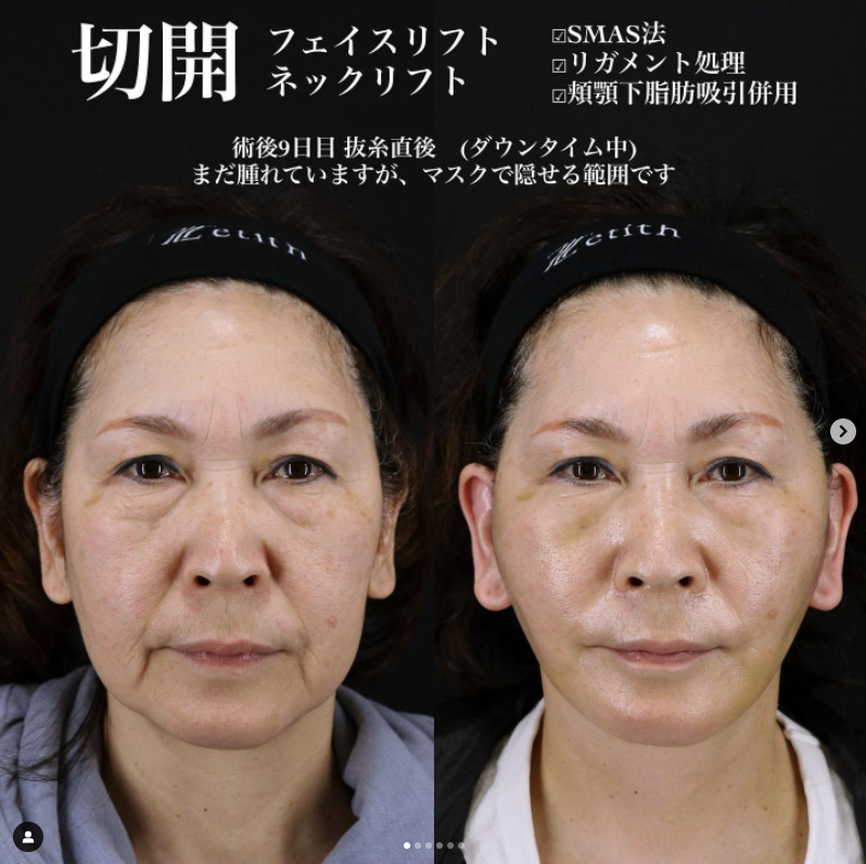 《術後9日目》王医師による切開フェイスリフト＋ネックリフト