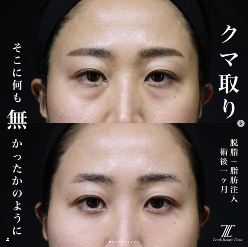 《術後1ヶ月》王医師によるクマ取り＋脂肪注入