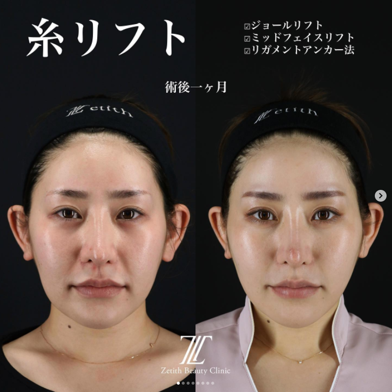 《術後1ヶ月》王医師による糸リフト