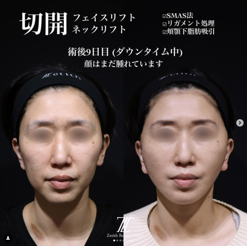 《術後9日目》王医師による切開フェイスリフト＋ネックリフト