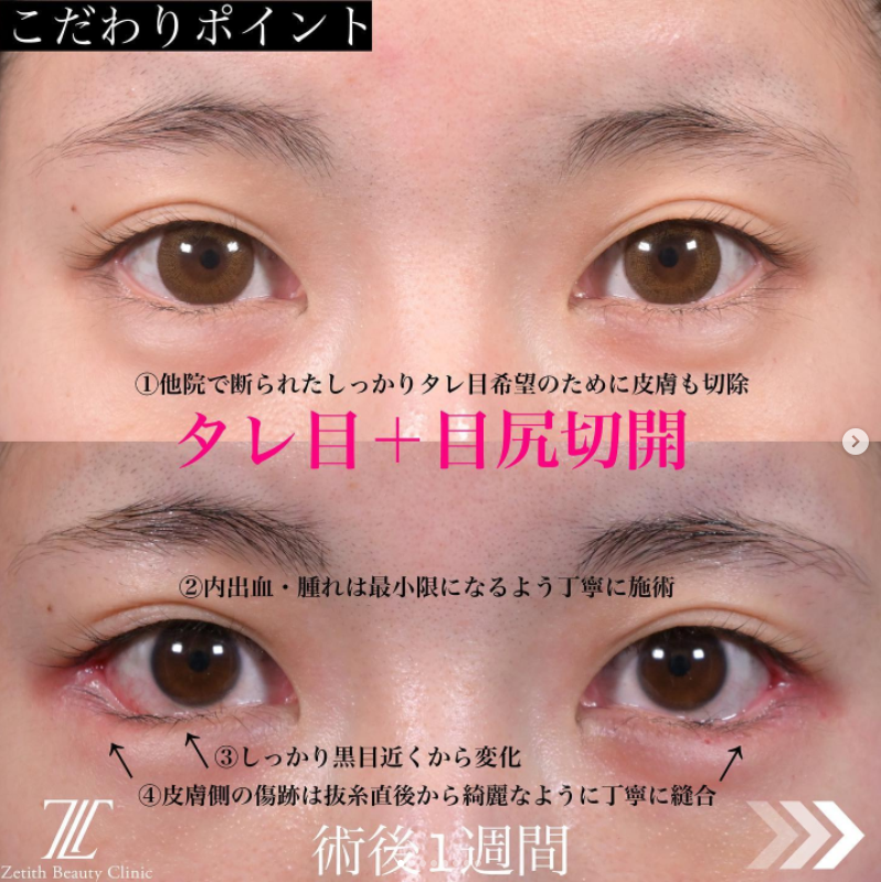 《術後1週間》上木原医師によるタレ目形成＋目尻切開