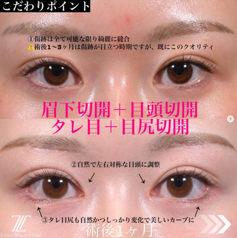 《術後1ヶ月》上木原医師による眉下切開＋目頭切開＋目尻切開＋タレ目形成