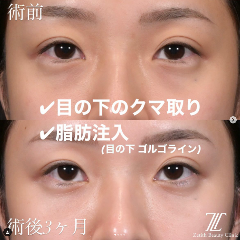 《術後3ヶ月》新井医師によるクマ取り＋脂肪注入