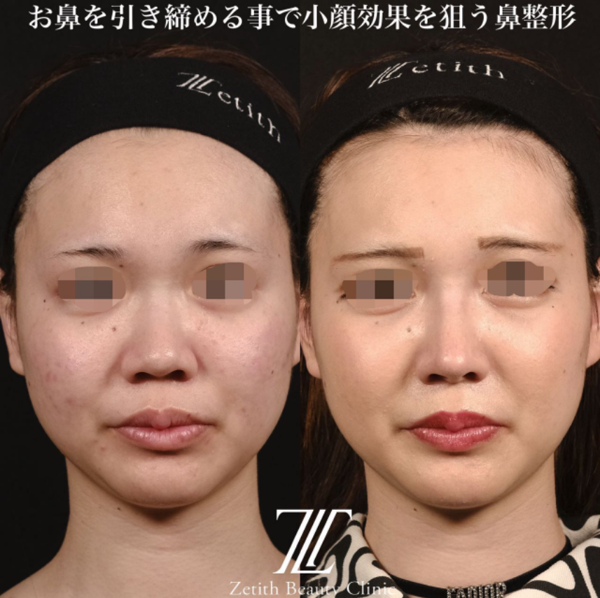 鉄医師による鼻のフルコースの施術前／施術後1ヶ月