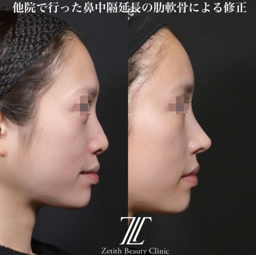 鉄医師による鼻のフルコースの施術前／施術後4ヶ月