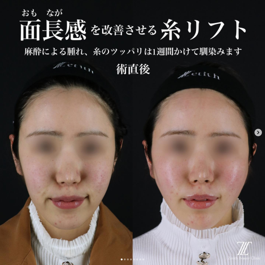 《術直後》王医師による糸リフト