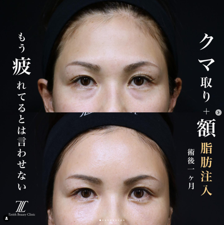 《術後1ヶ月》王医師によるクマ取り＋脂肪注入
