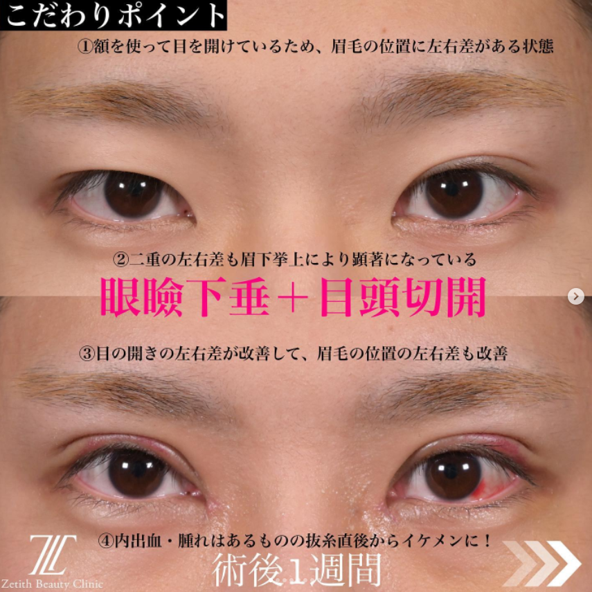 《術後1週間》上木原医師による眼瞼下垂＋目頭切開