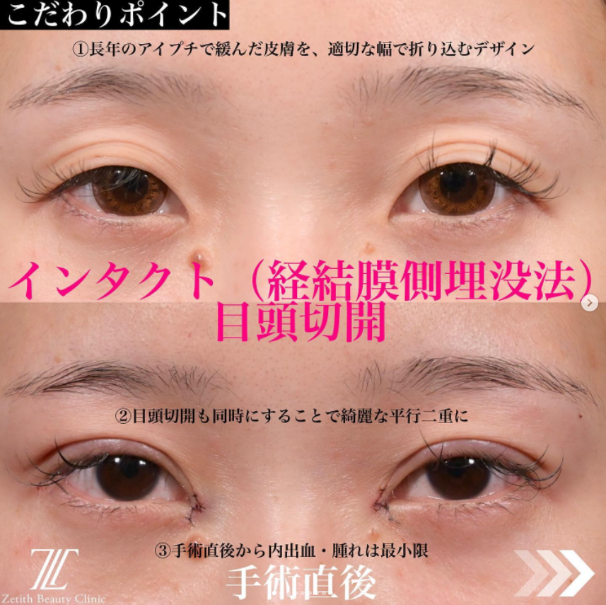 《術直後》上木原医師による二重埋没法＋目頭切開