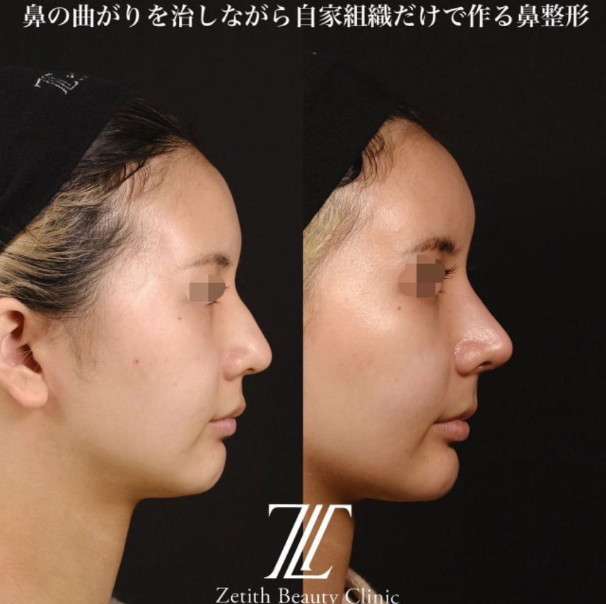 鉄医師による鼻のフルコースの施術前／施術後1ヶ月
