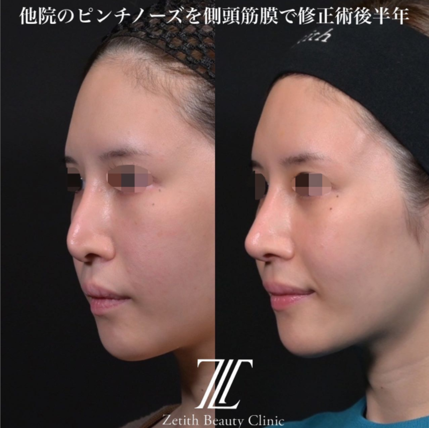 鉄医師による鼻のフルコースの施術前／施術後6ヶ月