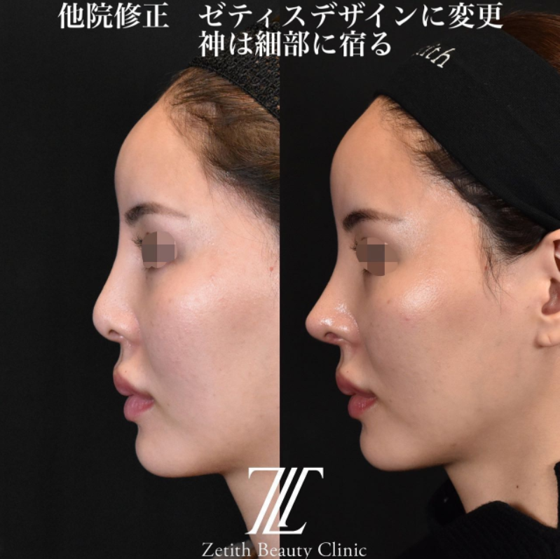 鉄医師による鼻のフルコースの施術前／施術後4ヶ月