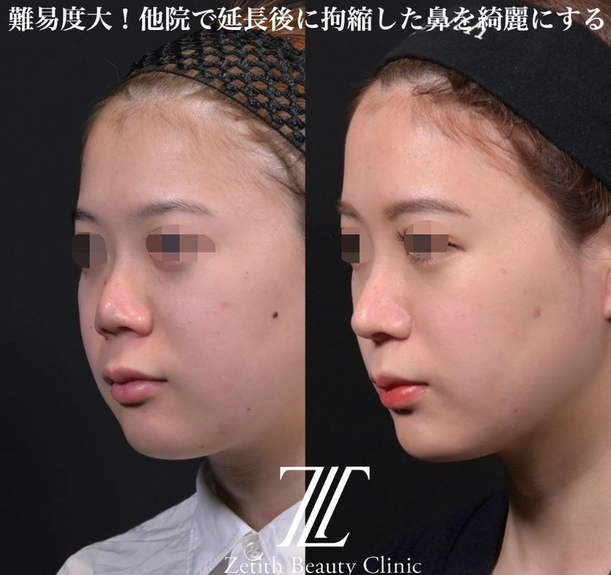 鉄医師による鼻のフルコースの施術前／施術後
