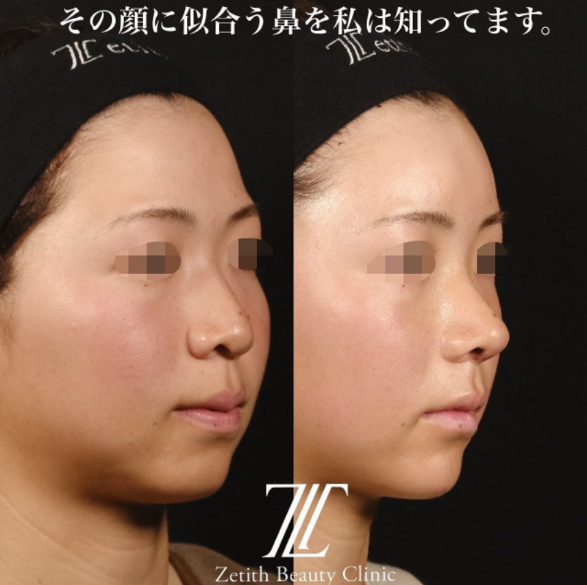 鉄医師による鼻のフルコースの施術前／施術後1ヶ月 Дараа 