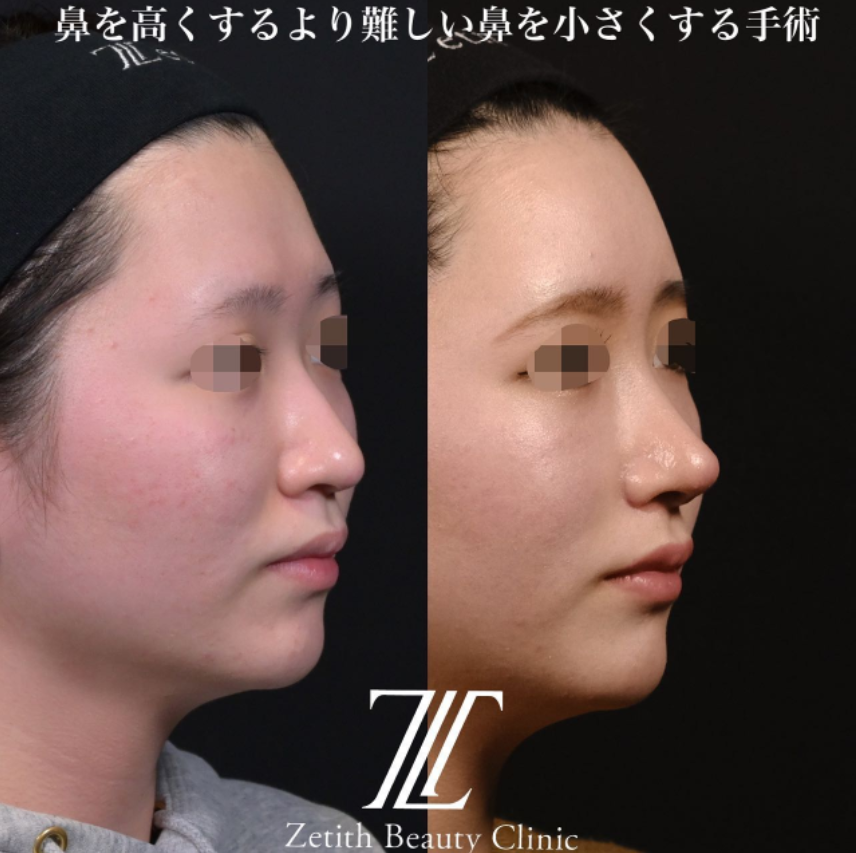 鉄医師による鼻のフルコースの施術前／施術後1ヶ月 施術後 