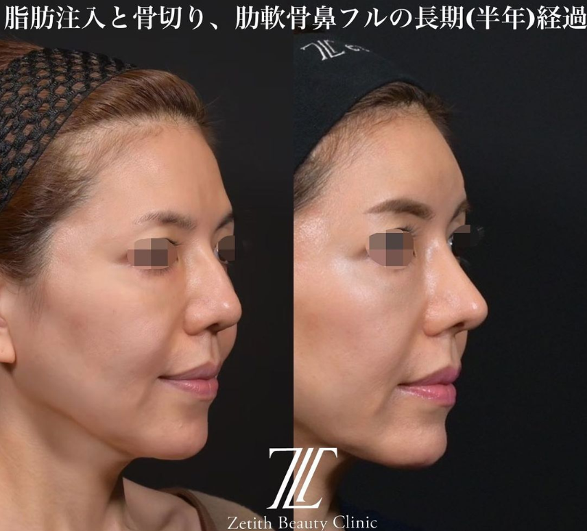 鉄医師による鼻のフルコースの施術前／施術後6ヶ月