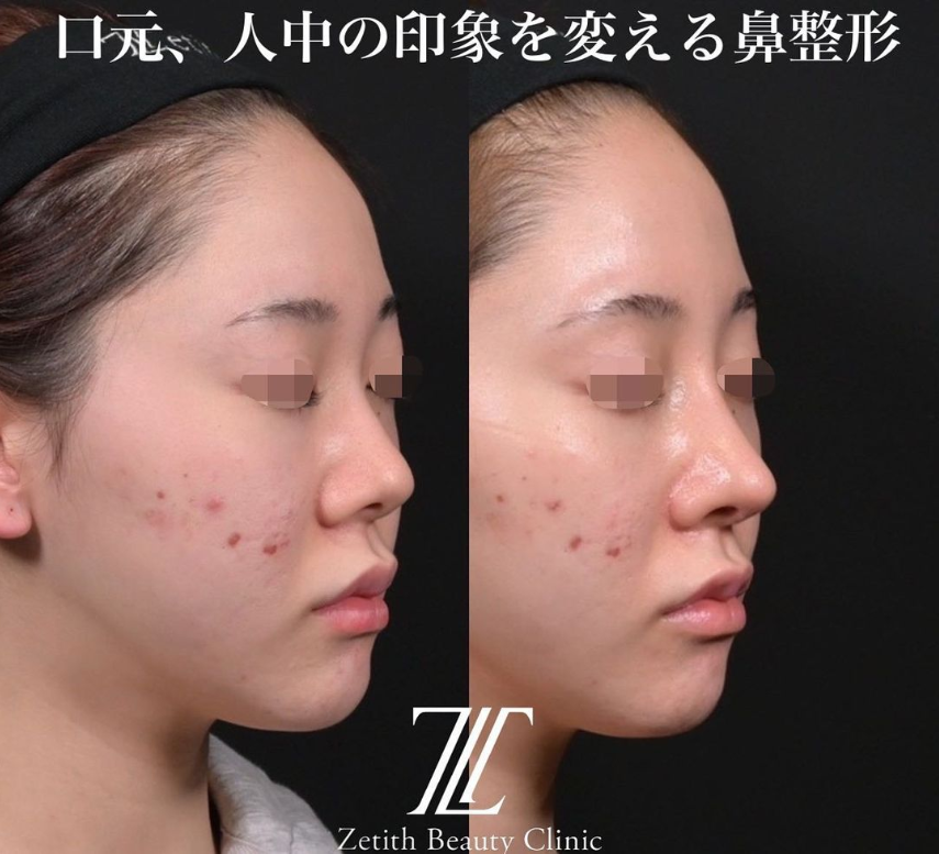鉄医師による鼻のフルコースの施術前／施術後1ヶ月 Дараа 