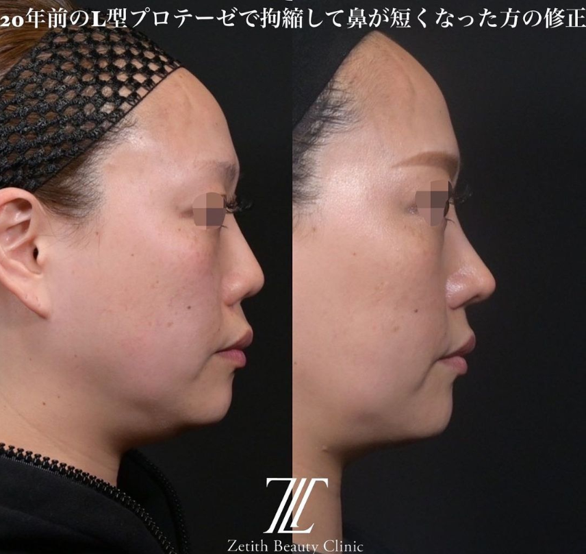 鉄医師による鼻のフルコースの施術前／施術後3ヶ月