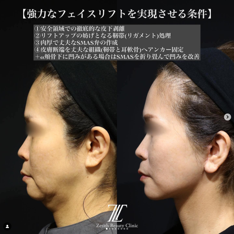 《術後1ヶ月》王医師によるフェイスリフト＋ネックリフト 施術後 