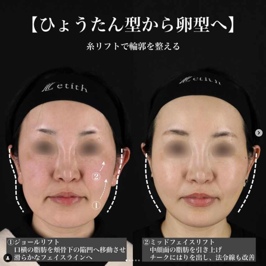 《術後1週間》王医師による糸リフト Sonra 
