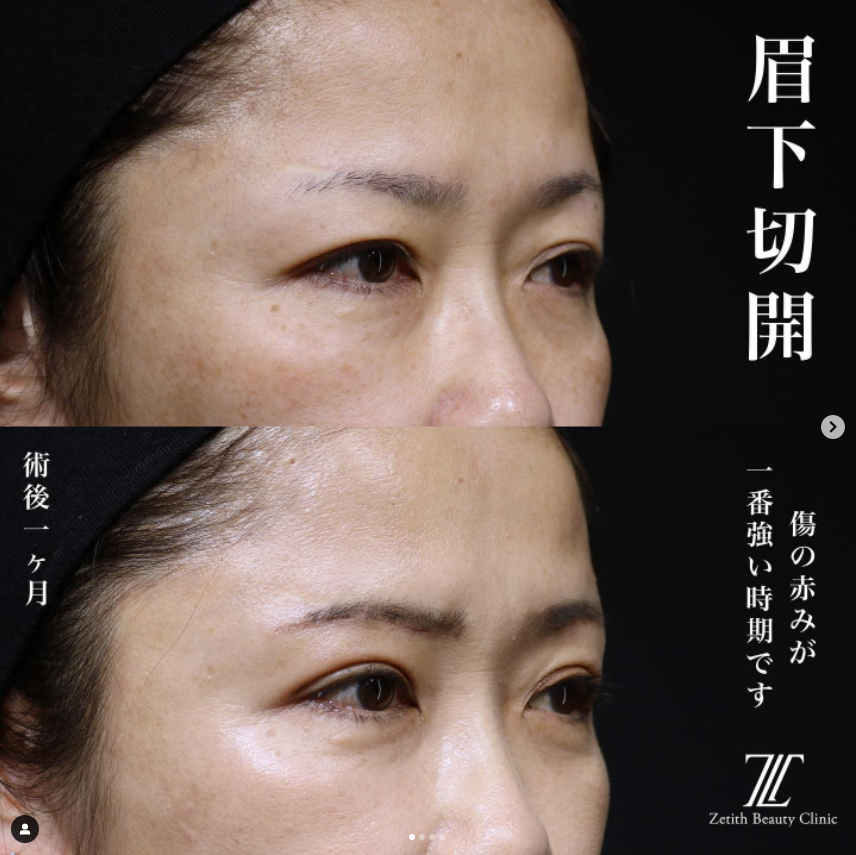 《術後1ヶ月》王医師による眉下切開 术后 