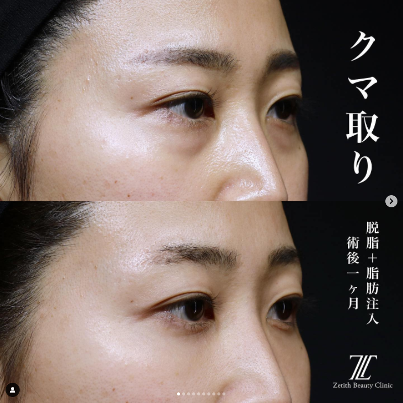 《術後1ヶ月》王医師によるクマ取り＋脂肪注入 بعد 