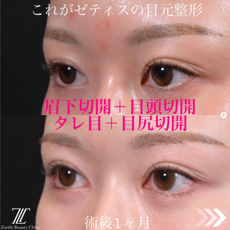 《術後1ヶ月》上木原医師による眉下切開＋目頭切開＋目尻切開＋タレ目形成 术后 