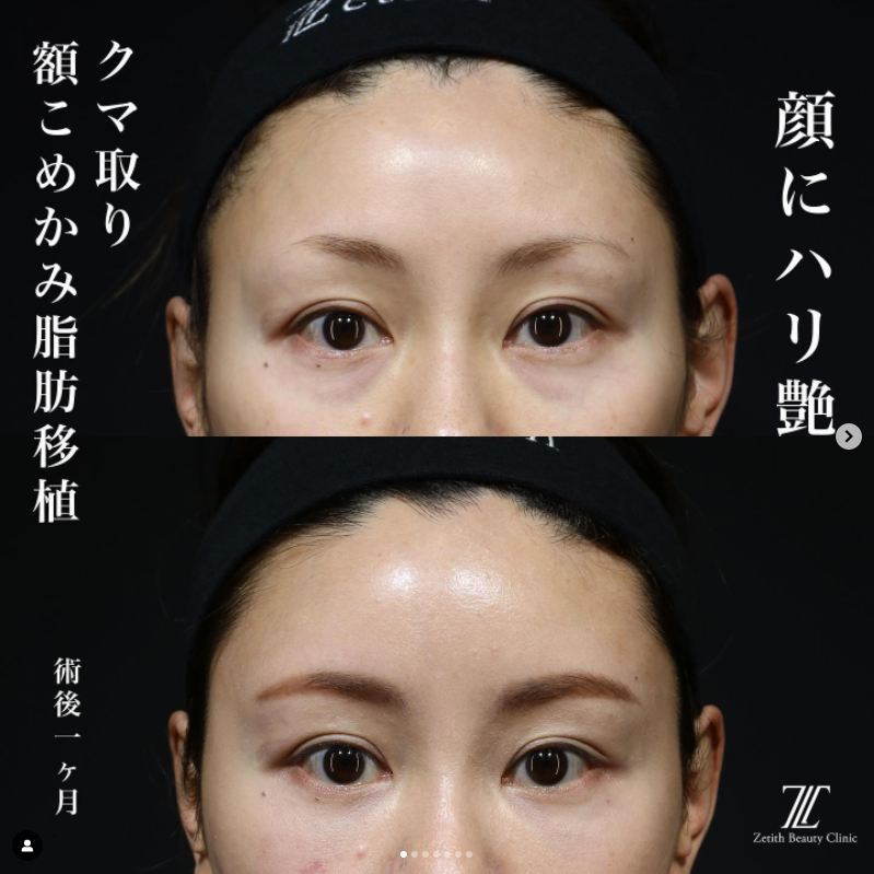 《術後1ヶ月》上木原医師によるクマ取り＋脂肪注入