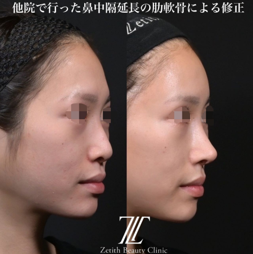 鉄医師による鼻のフルコースの施術前／施術後4ヶ月 Дараа 