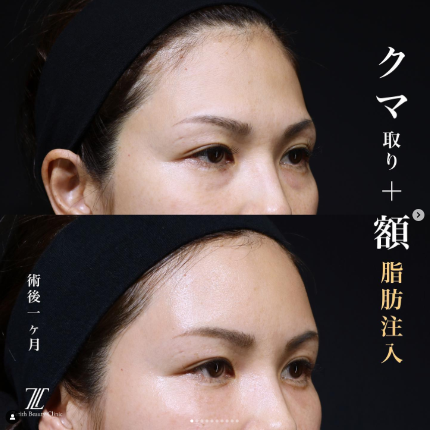 《術後1ヶ月》王医師によるクマ取り＋脂肪注入 术后 
