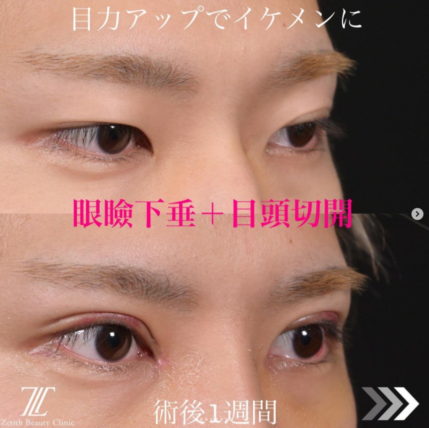 《術後1週間》上木原医師による眼瞼下垂＋目頭切開 术后 
