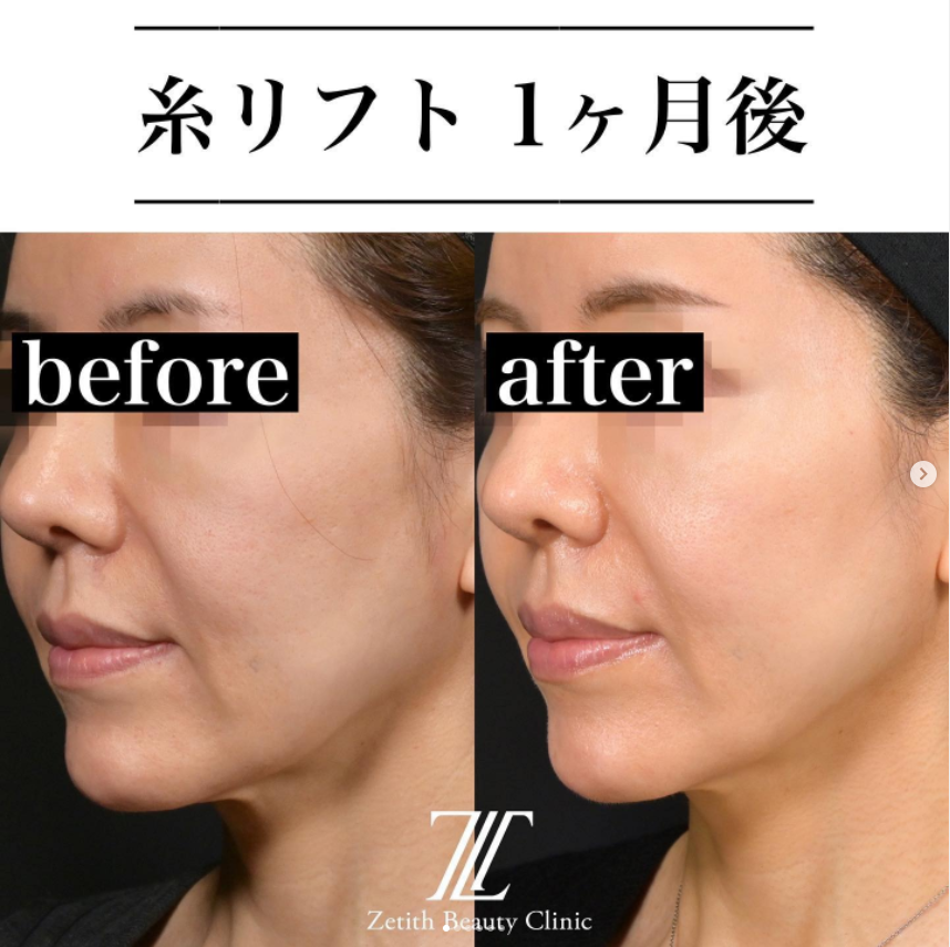 《術後1ヶ月》新井医師による糸リフト