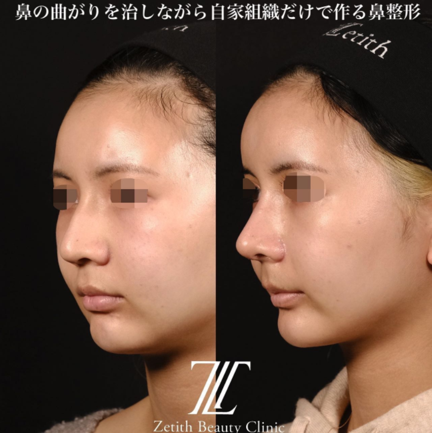 鉄医師による鼻のフルコースの施術前／施術後1ヶ月 施術後 