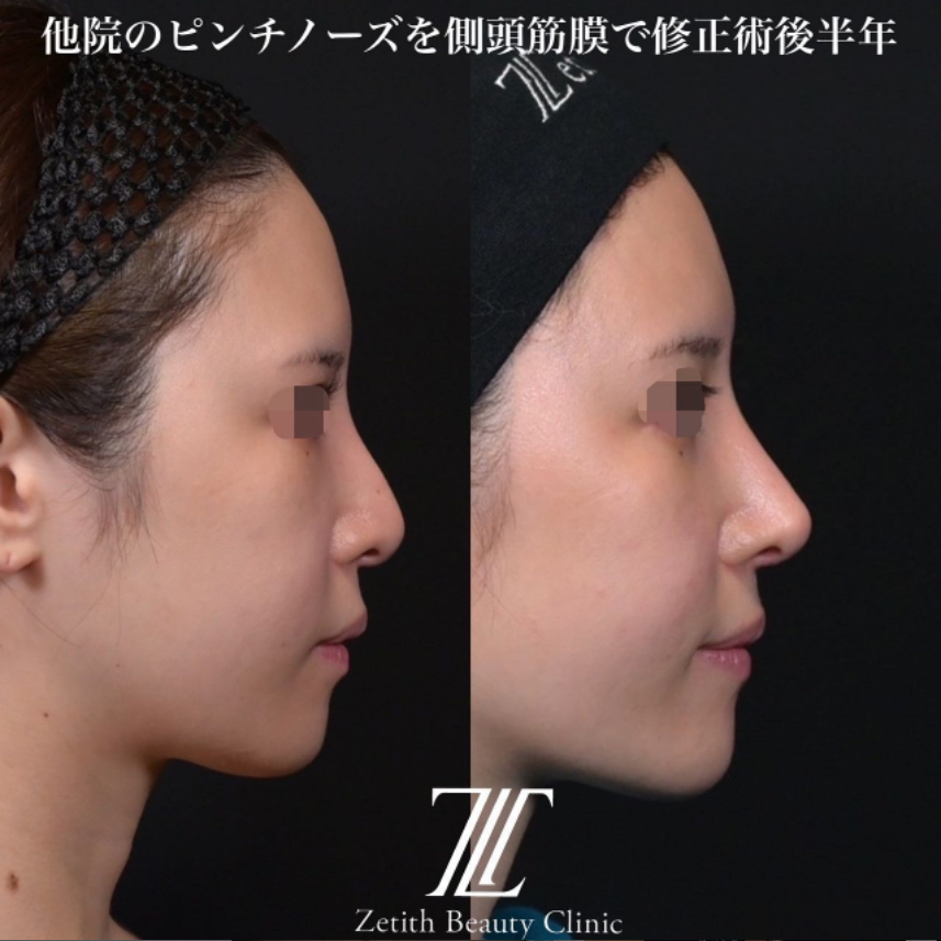 鉄医師による鼻のフルコースの施術前／施術後6ヶ月 术后 