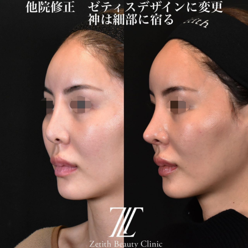 鉄医師による鼻のフルコースの施術前／施術後4ヶ月 施術後 