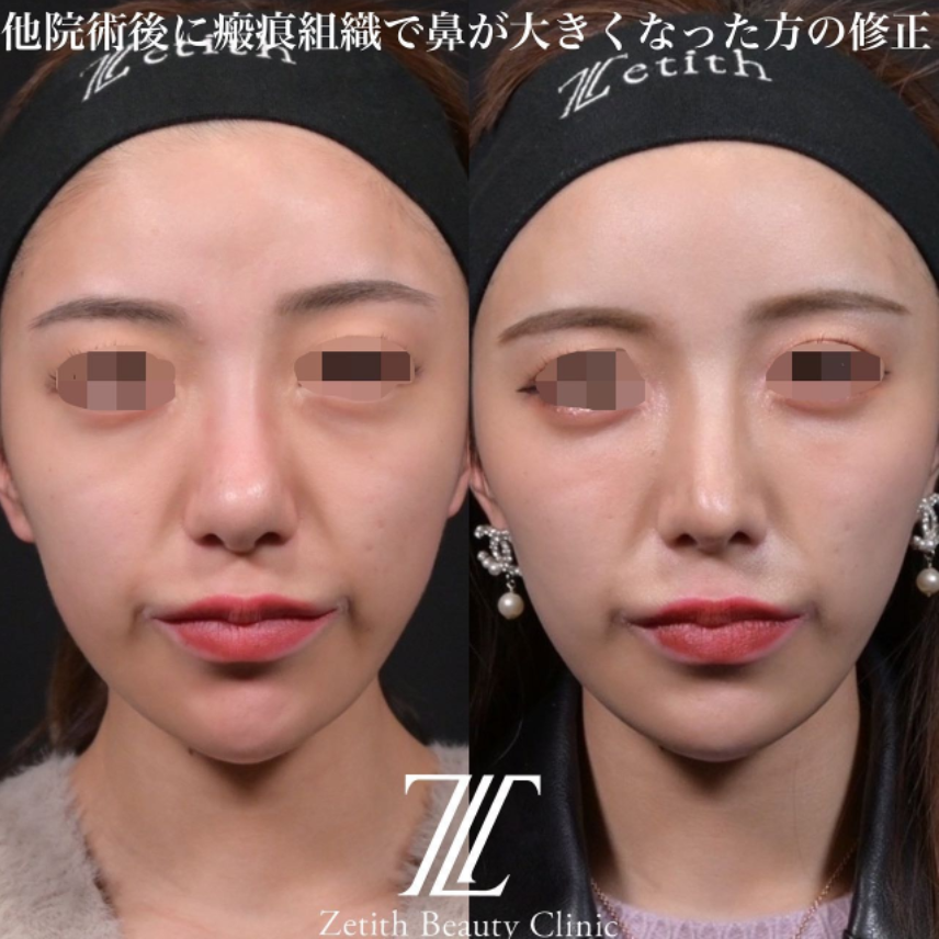 鉄医師による鼻のフルコースの施術前／施術後1ヶ月