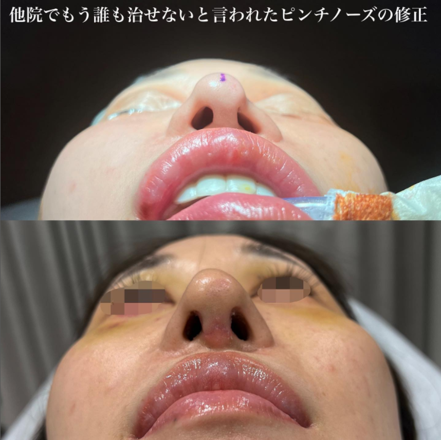 鉄医師による鼻のフルコースの施術前／施術後1週間