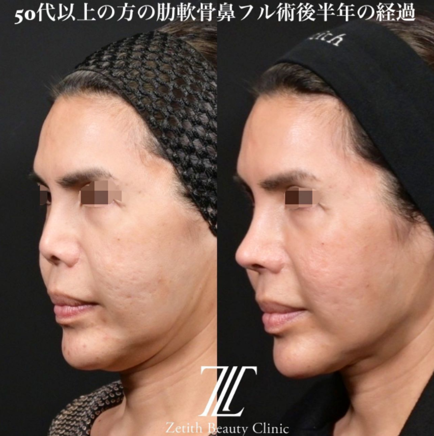 鉄医師による鼻のフルコースの施術前／施術後6ヶ月