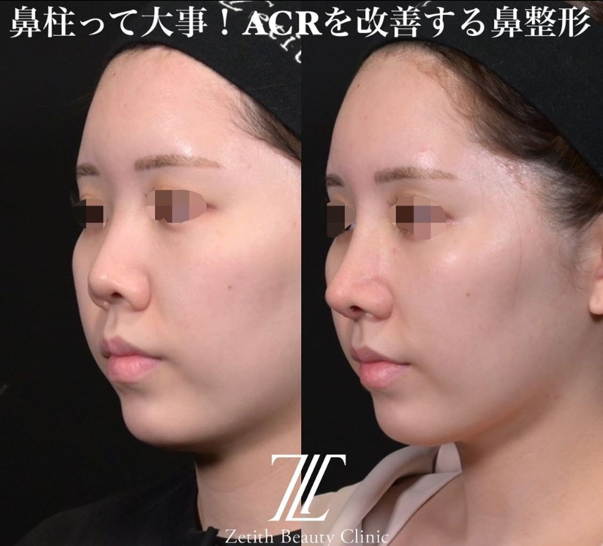 鉄医師による鼻のフルコースの施術前／施術後2週間 หลัง 