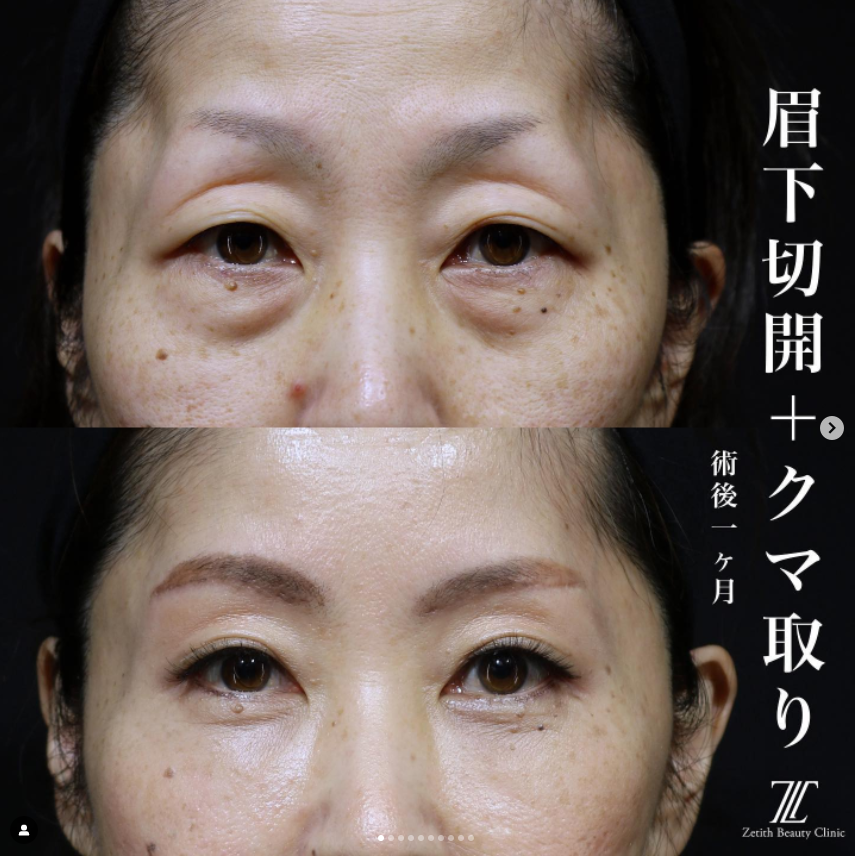 《術後1ヶ月》王医師による眉下切開＋クマ取り