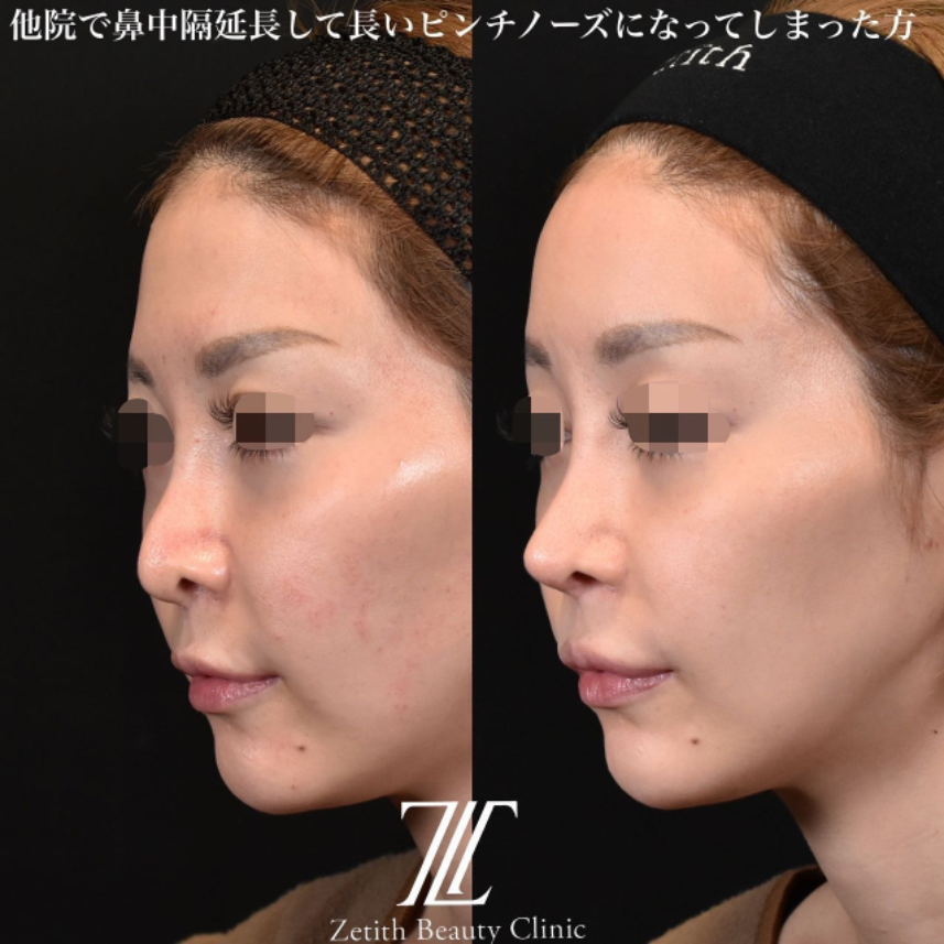 鉄医師による鼻のフルコースの施術前／施術後3ヶ月