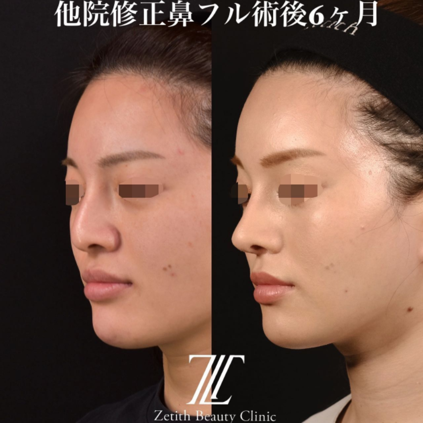 鉄医師による鼻のフルコースの施術前／施術後6ヶ月