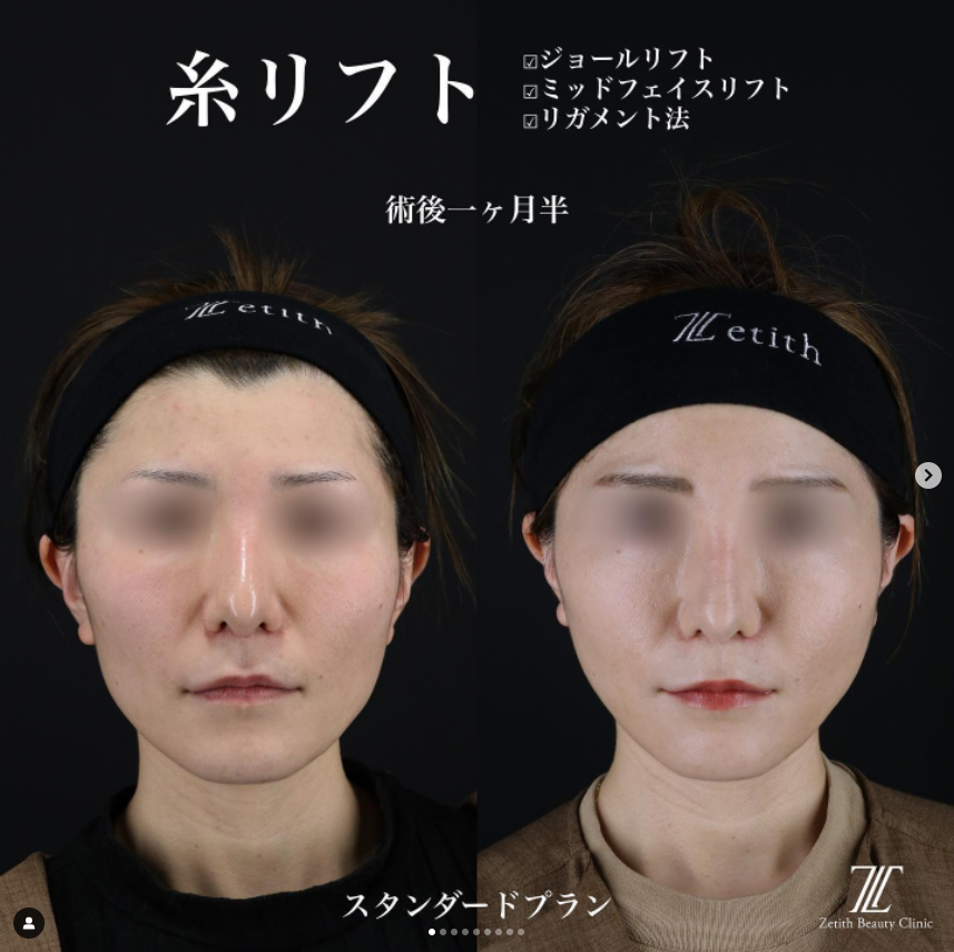 《術後1ヶ月半》王医師による糸リフト